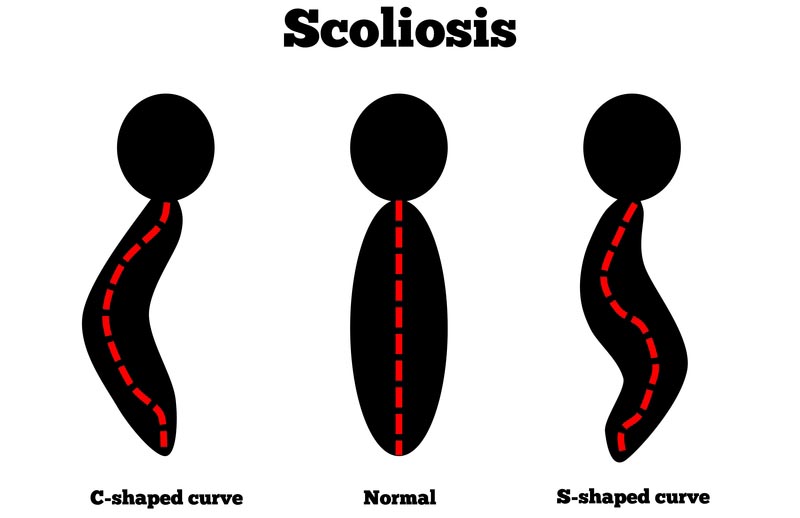 Rockville, Maryland scoliosis treatment